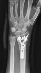 Wrist fracture Treatment